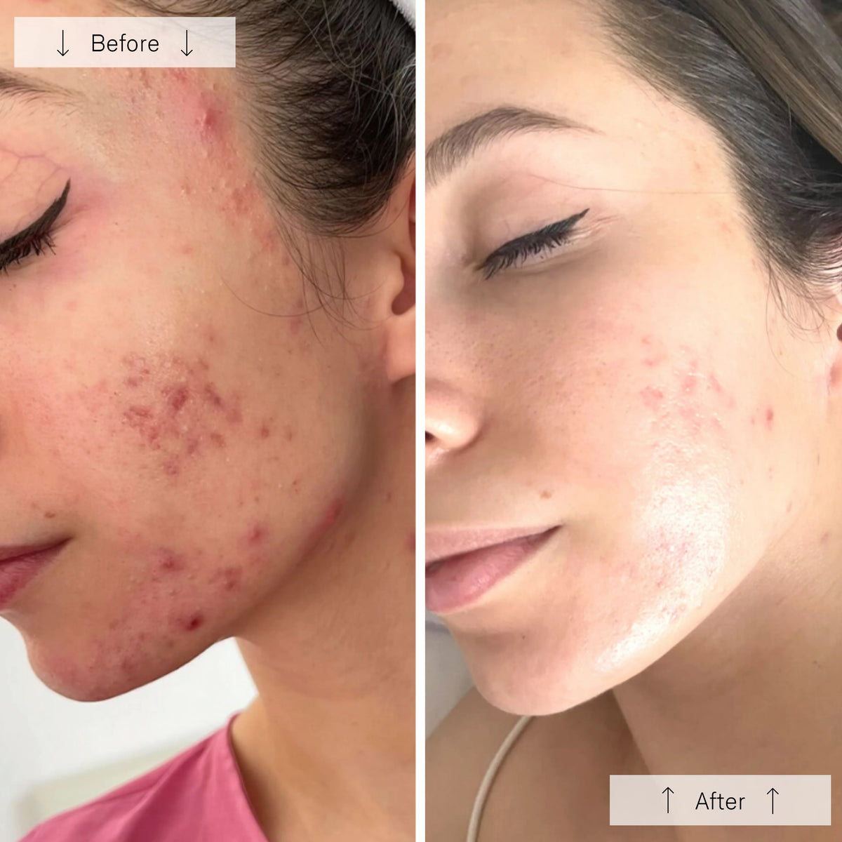 Omnilux Clear Face Mask